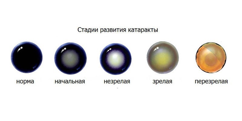 Катаракта - симптоми, причини та різновиди, медикаментозна терапія та хірургічне втручання