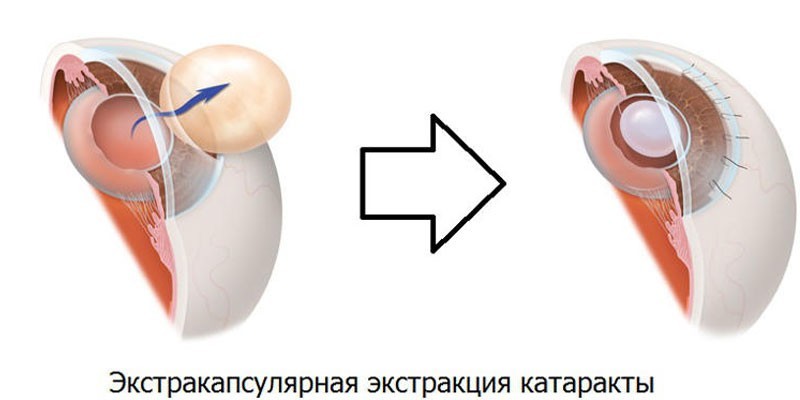 Катаракта - симптоми, причини та різновиди, медикаментозна терапія та хірургічне втручання