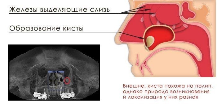 Кіста гайморової пазухи - причини, ознаки та видалення