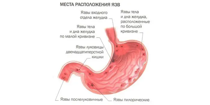 Класифікація виразкової хвороби шлунка за ознаками, причинами розвитку