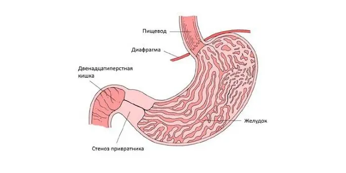 Класифікація виразкової хвороби шлунка за ознаками, причинами розвитку