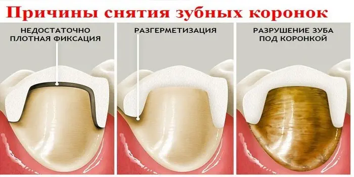 Коронка на зуб - матеріали імплантів та методи фіксації, вартість