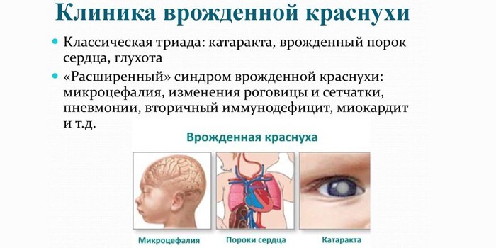 Краснуха – ознаки, як лікувати та вакцини для профілактики