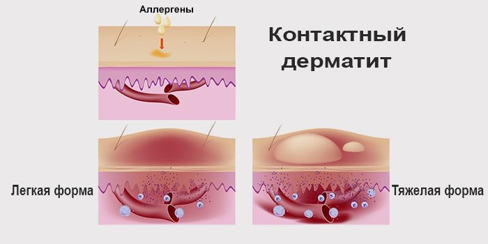 Лікування шкірних захворювань голови у людини