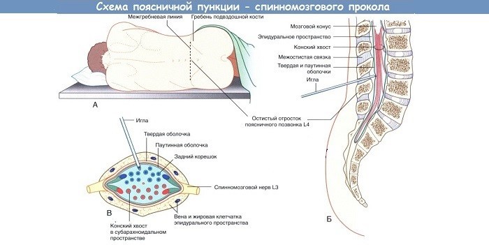 Люмбальна пункція: процедура проведення