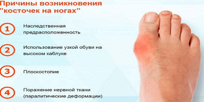 Медикаментозне лікування артриту стопи - список препаратів з інструкцією та цінами