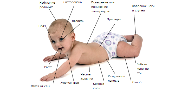 Менінгіт у новонароджених - ознаки, стадії та методи лікування