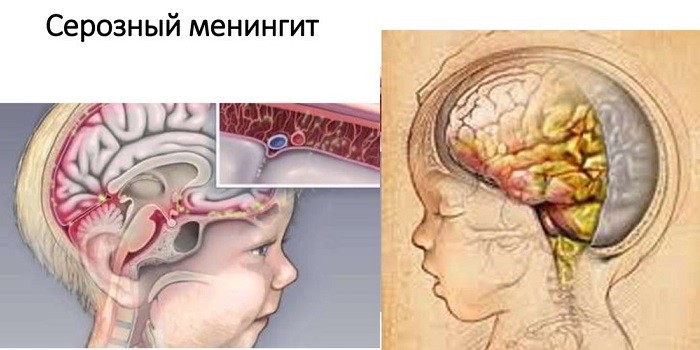 Менінгіт у новонароджених - ознаки, стадії та методи лікування