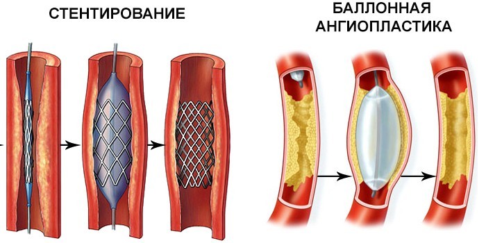 Нестабільна стенокардія - класифікація за Браунвальдом, діагностика та терапія