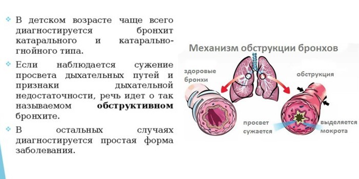Обструктивний бронхіт у дітей - як лікувати препаратами та народними засобами