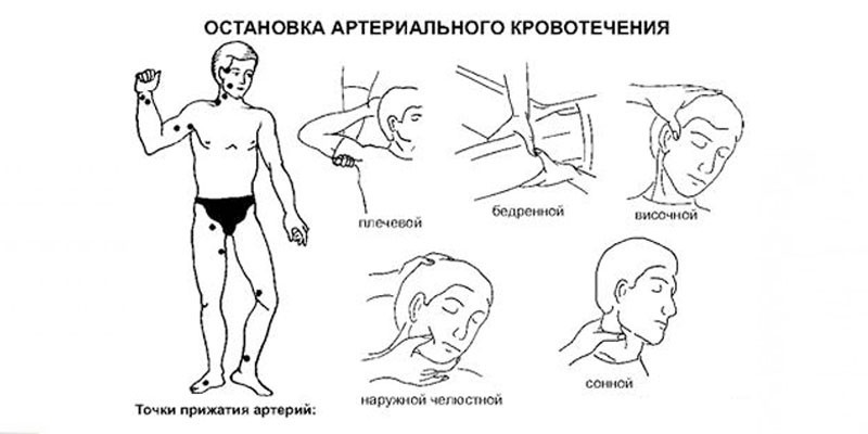 Зупинка артеріальної кровотечі - алгоритм дій