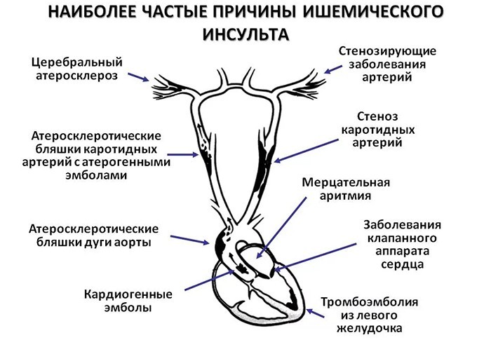 Від чого може бути ішемічний або геморагічний інсульт