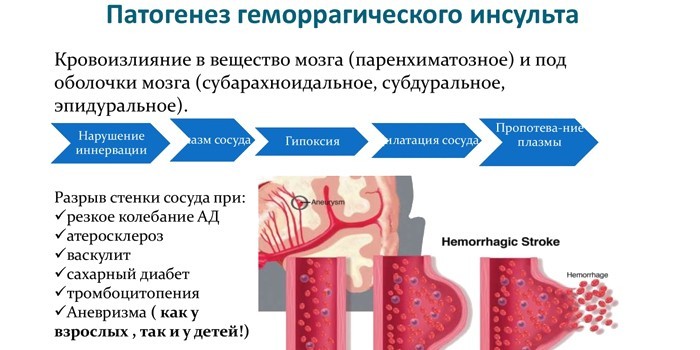Від чого може бути ішемічний або геморагічний інсульт
