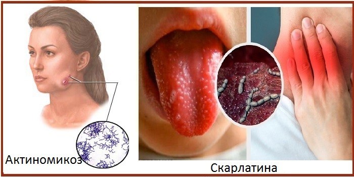 Періостит верхньої та нижньої щелепи: симптоми та лікування