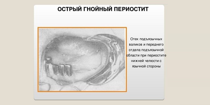 Періостит верхньої та нижньої щелепи: симптоми та лікування