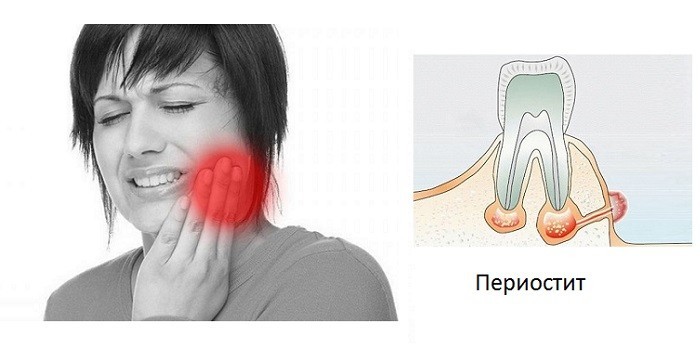 Періостит верхньої та нижньої щелепи: симптоми та лікування