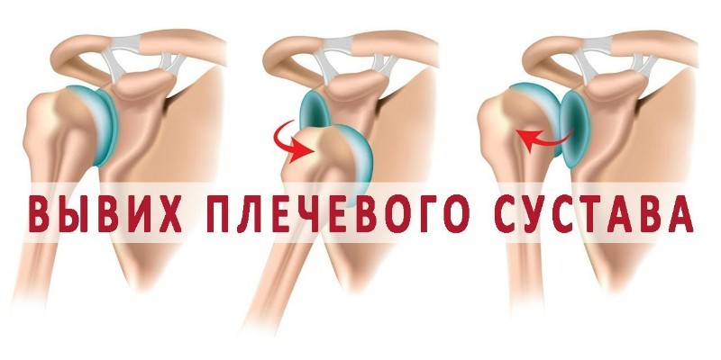 Перша допомога при вивиху суглоба - доброчебна та медична.