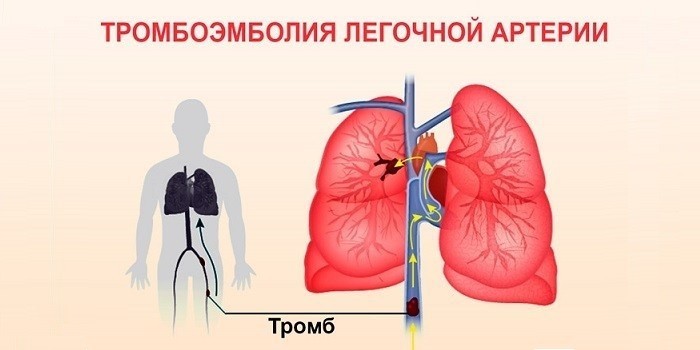 Пневмосклероз - симптоми, лікування і чим небезпечний