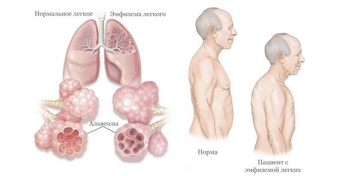 Пневмосклероз - симптоми, лікування і чим небезпечний