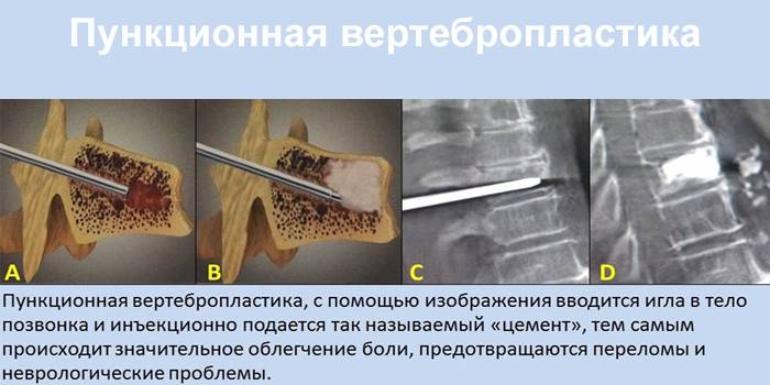 Причини болю у спині