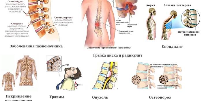 Причини болю у спині