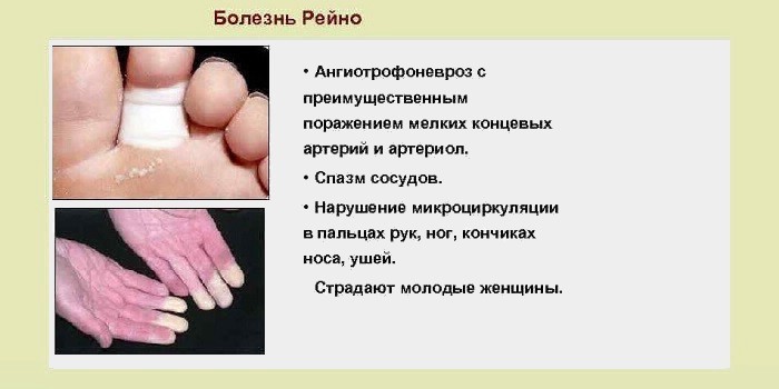 Причини холодних ніг, лікування порушень кровообігу
