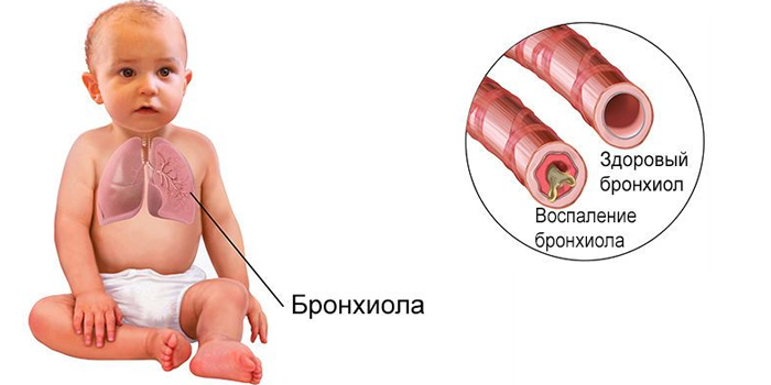 Причини та симптоми хронічного бронхіту з бронхообструктивним синдромом