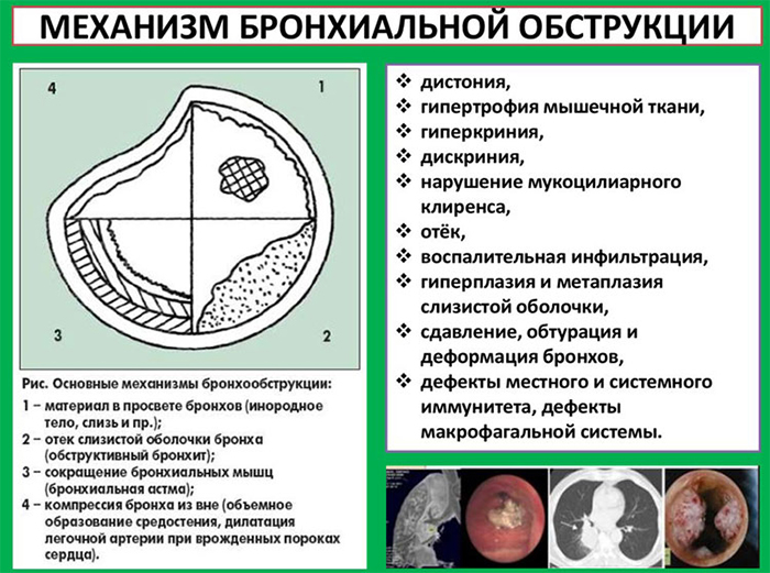 Причини та симптоми хронічного бронхіту з бронхообструктивним синдромом