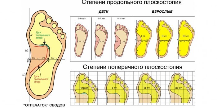 Ознаки плоскостопості у дітей – клінічні прояви, способи терапії, наслідки