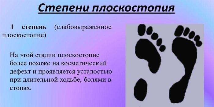Ознаки плоскостопості у дорослих - як визначити хворобу за видом та причинами