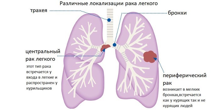 Ознаки раку легенів на ранніх та пізніх стадіях