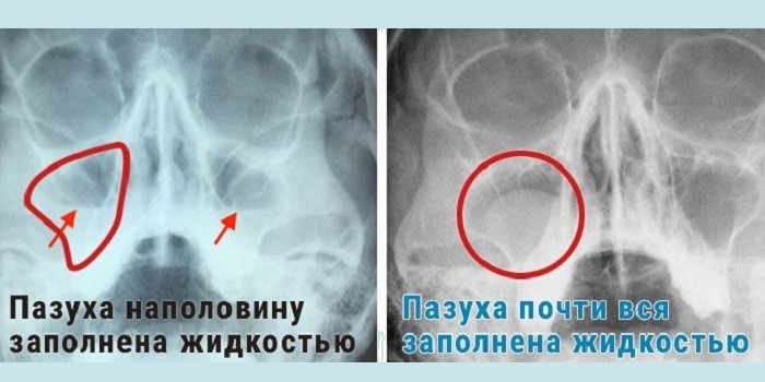 Рентген пазух носа при гаймориті - опис знімків