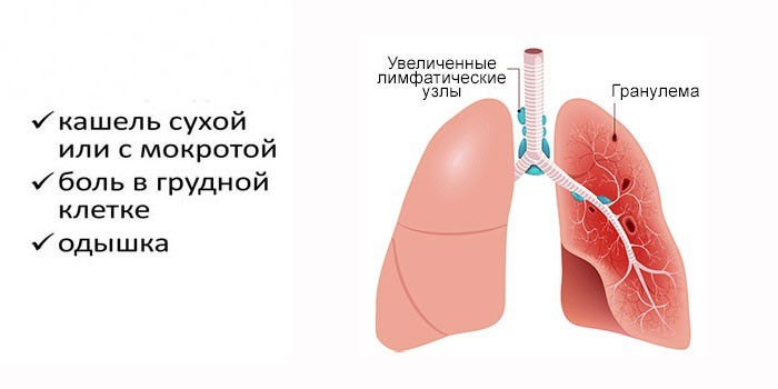 Саркоїдоз легких та внутрішньогрудних лімфатичних вузлів.