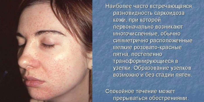 Саркоїдоз легких та внутрішньогрудних лімфатичних вузлів.