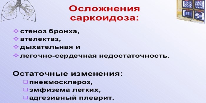 Саркоїдоз легких та внутрішньогрудних лімфатичних вузлів.