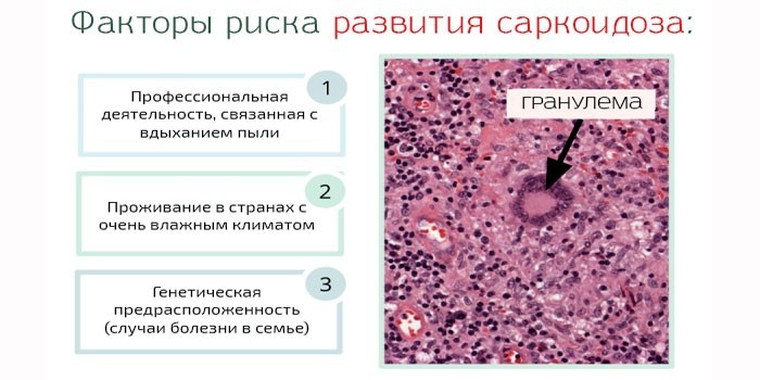 Саркоїдоз легких та внутрішньогрудних лімфатичних вузлів.