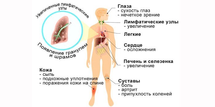 Саркоїдоз легких та внутрішньогрудних лімфатичних вузлів.