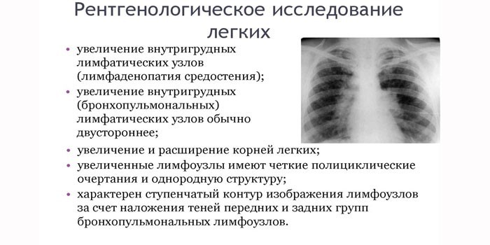 Саркоїдоз легких та внутрішньогрудних лімфатичних вузлів.