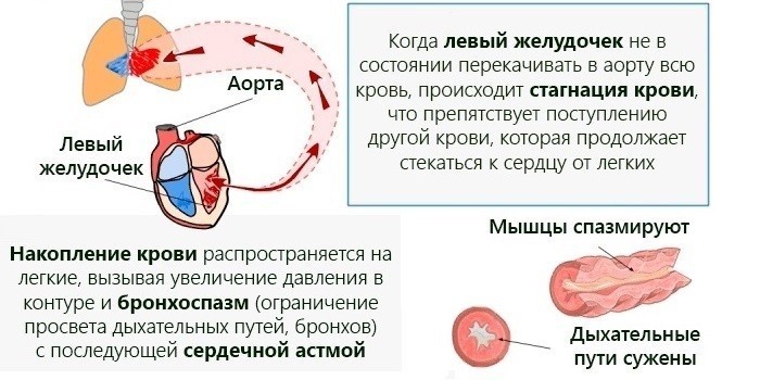 Серцевий кашель: як лікувати у дорослих