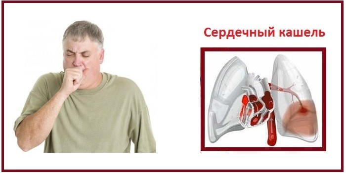 Серцевий кашель: як лікувати у дорослих
