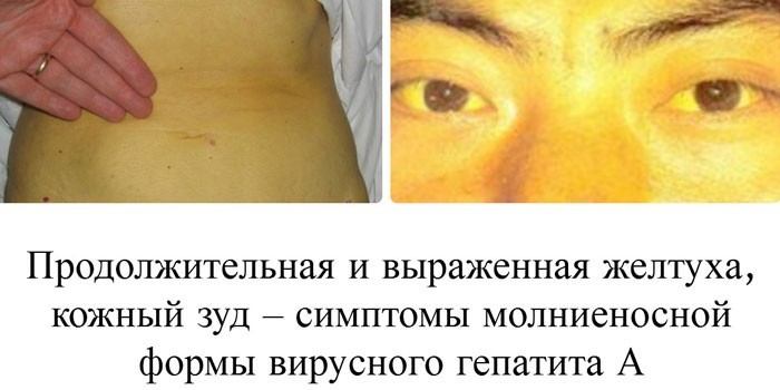 Симптоми гепатиту А – клінічна картина, діагностика, лікування
