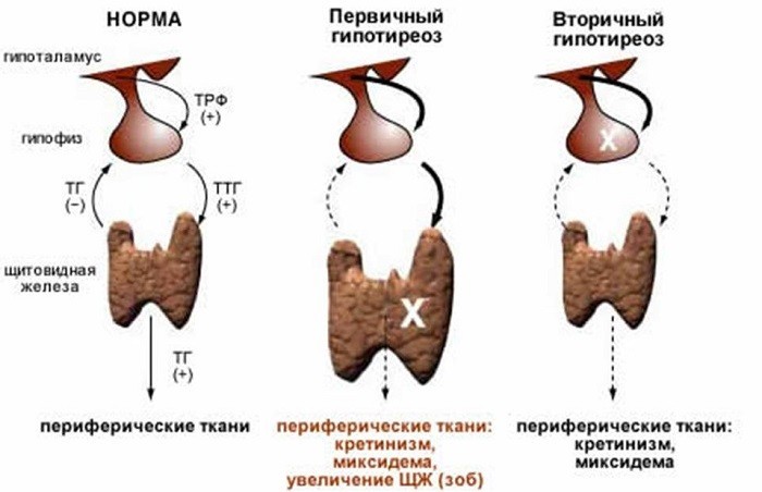 Симптоми та лікування гіпотиреозу