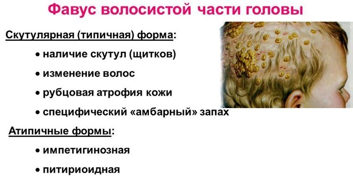 Симптоми та види мікозів шкіри людини