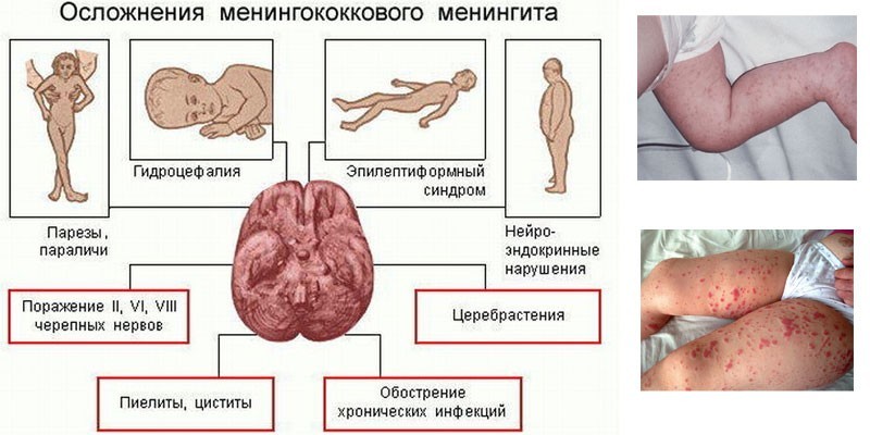 Симптоми менінгіту у дорослих – як розпізнати інфекцію на ранніх стадіях