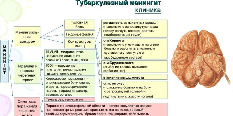 Симптоми менінгіту у дорослих – як розпізнати інфекцію на ранніх стадіях