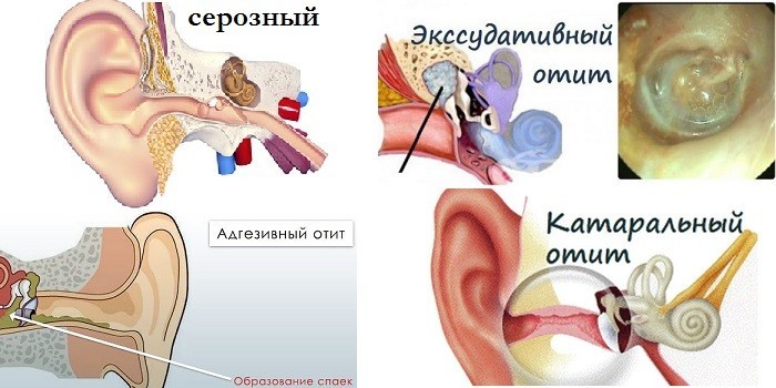Симптоми отиту середнього вуха гострого та хронічного