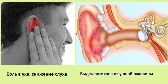 Симптоми отиту середнього вуха гострого та хронічного