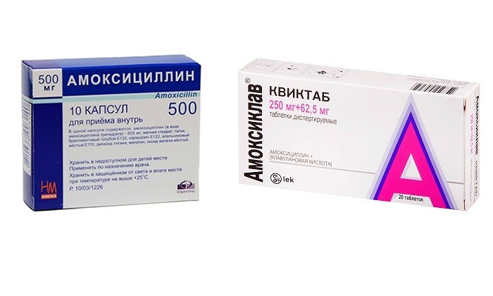 Синусит гострий та хронічний – ознаки, діагностика та як лікувати