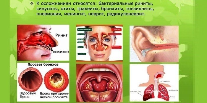Синусит гострий та хронічний – ознаки, діагностика та як лікувати