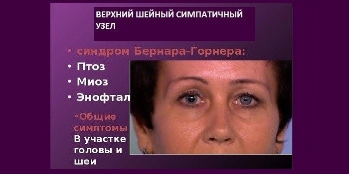Сирингомієлія шийного або грудного відділів хребта